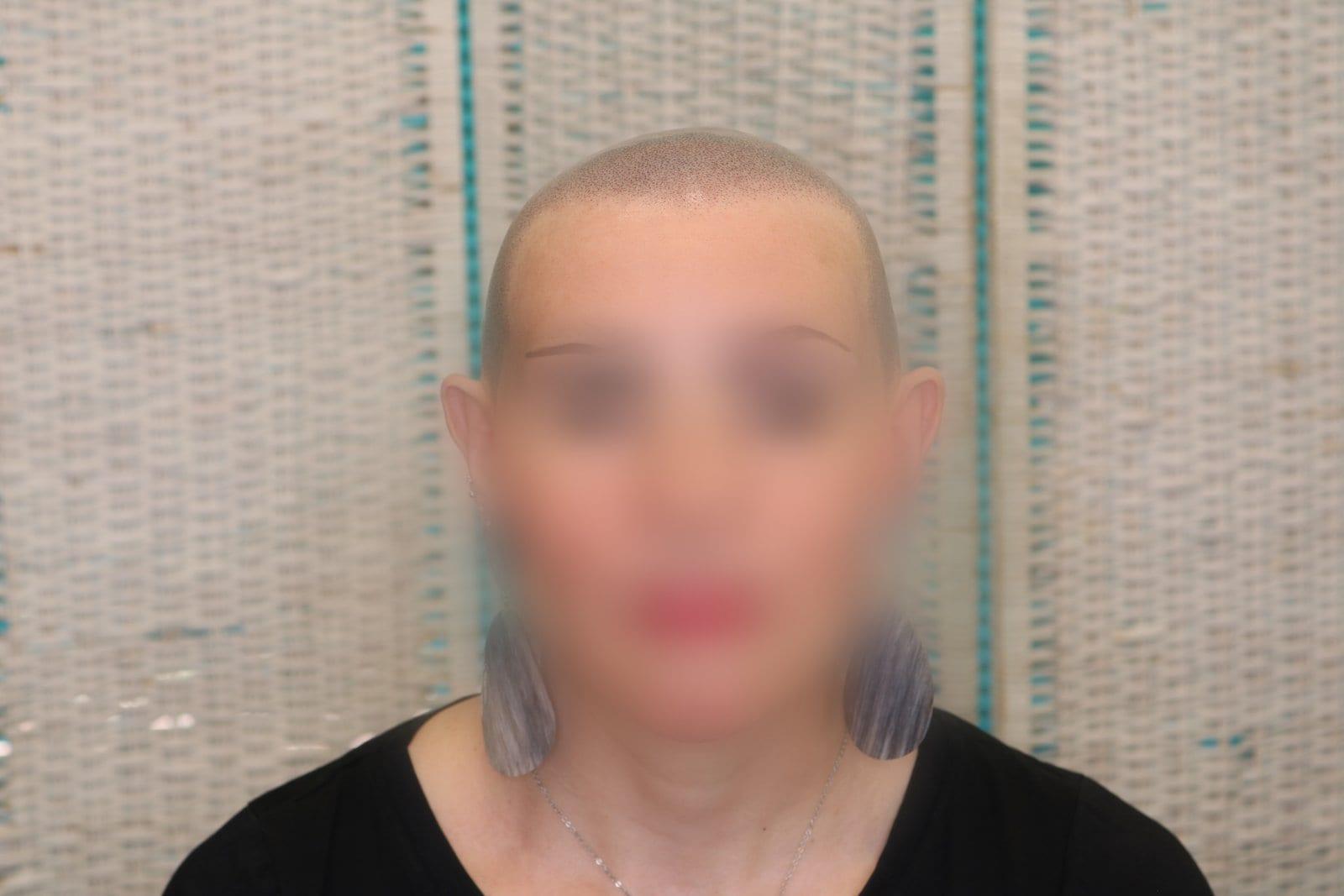Dopo: tricopigmentazione sezione donna a Firenze — Caso Prima / Dopo #5 (foto 6)