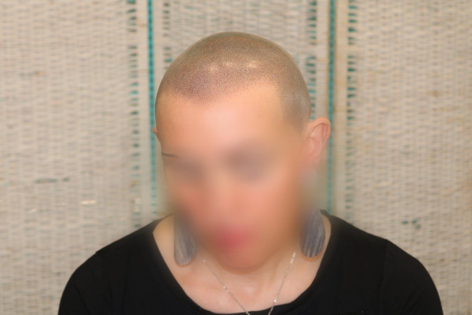 Dopo: tricopigmentazione sezione donna a Firenze — Caso Prima / Dopo #5 (foto 7)