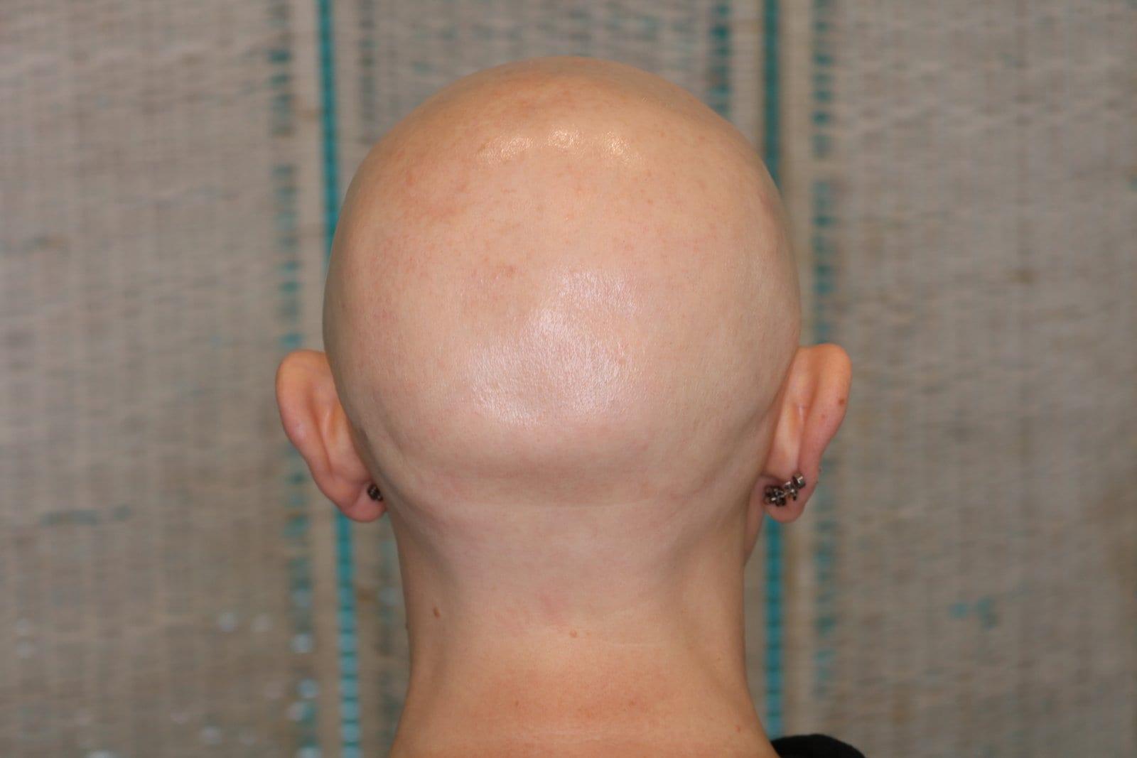 Prima: tricopigmentazione sezione donna a Firenze — Caso Prima / Dopo #5 (foto 1)