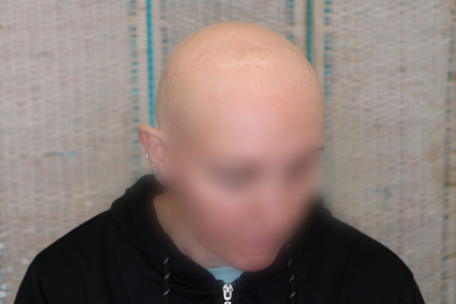 Prima: tricopigmentazione sezione donna a Firenze — Caso Prima / Dopo #5 (foto 2)