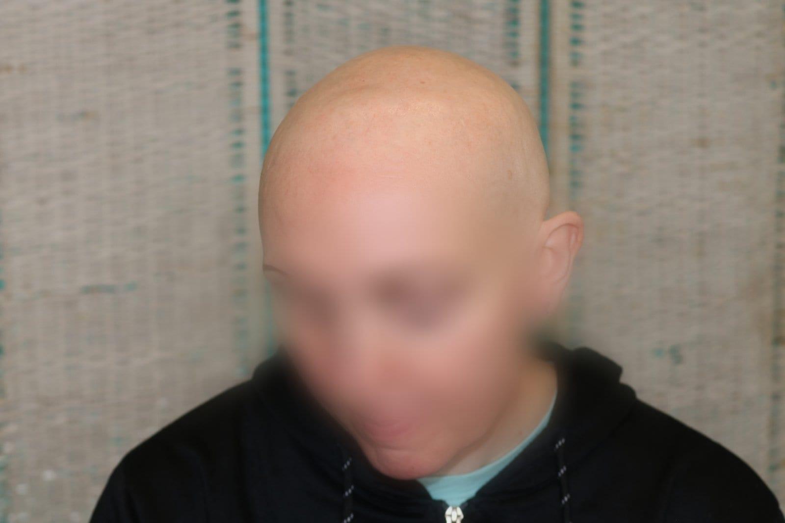 Prima: tricopigmentazione sezione donna a Firenze — Caso Prima / Dopo #5 (foto 3)