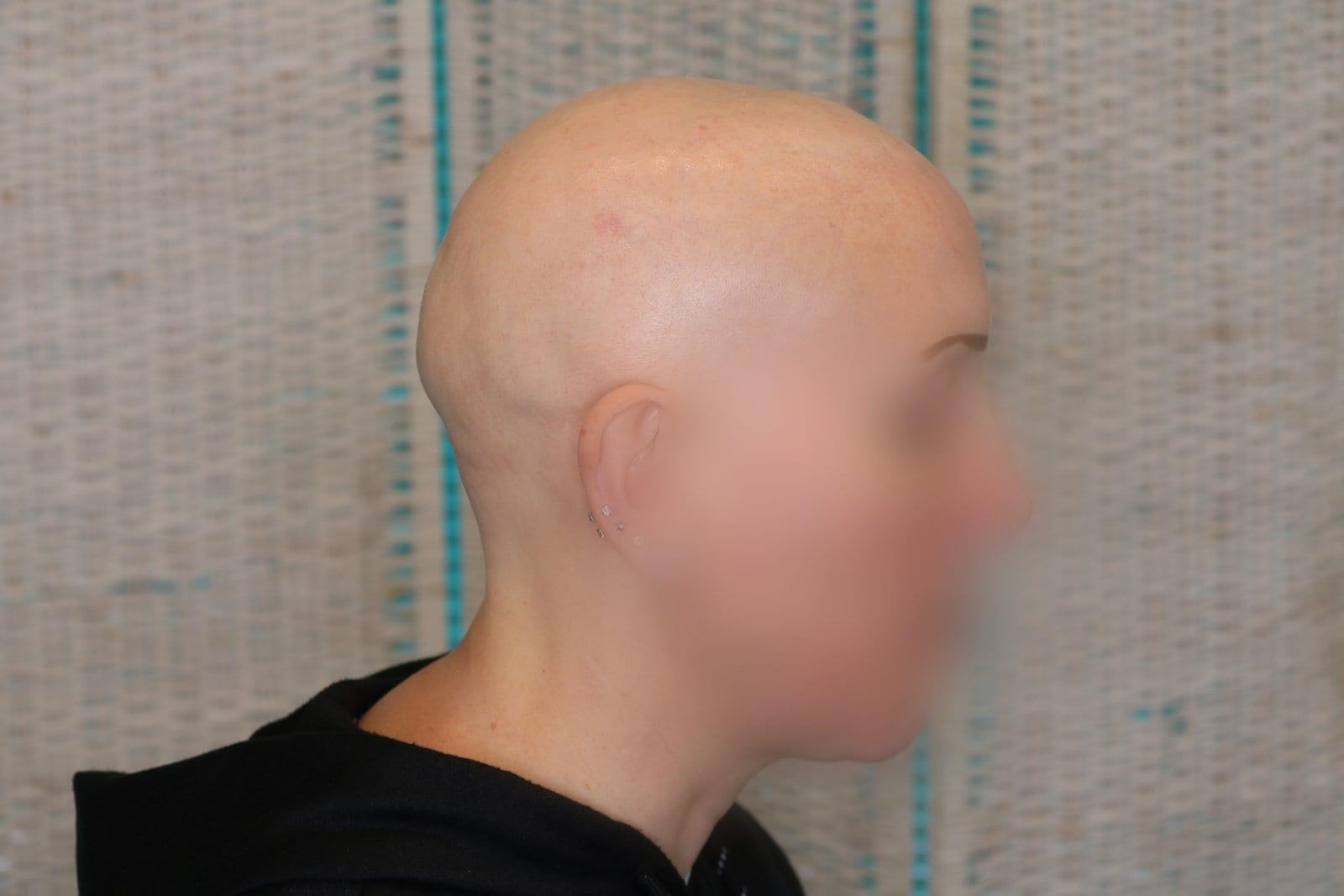 Prima: tricopigmentazione sezione donna a Firenze — Caso Prima / Dopo #5 (foto 4)