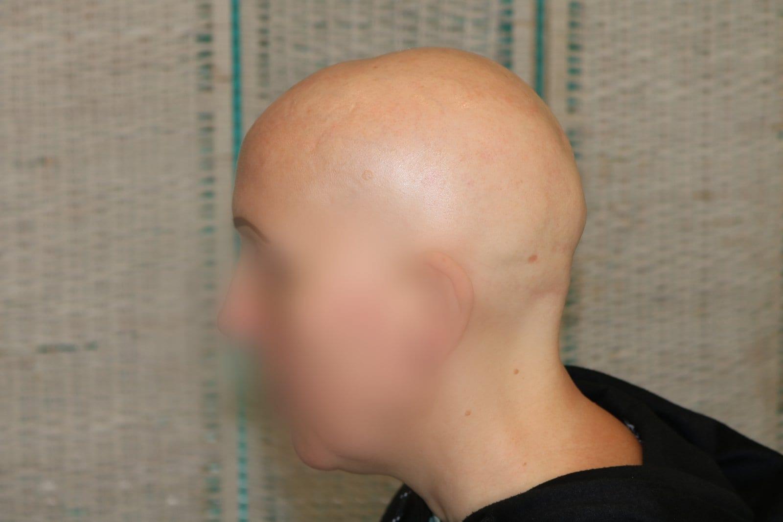 Prima: tricopigmentazione sezione donna a Firenze — Caso Prima / Dopo #5 (foto 6)