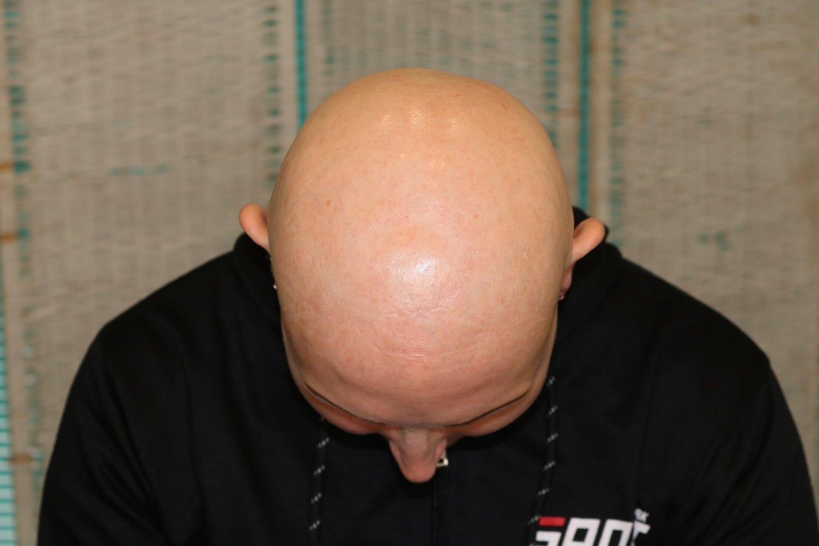Prima: tricopigmentazione sezione donna a Firenze — Caso Prima / Dopo #5 (foto 7)