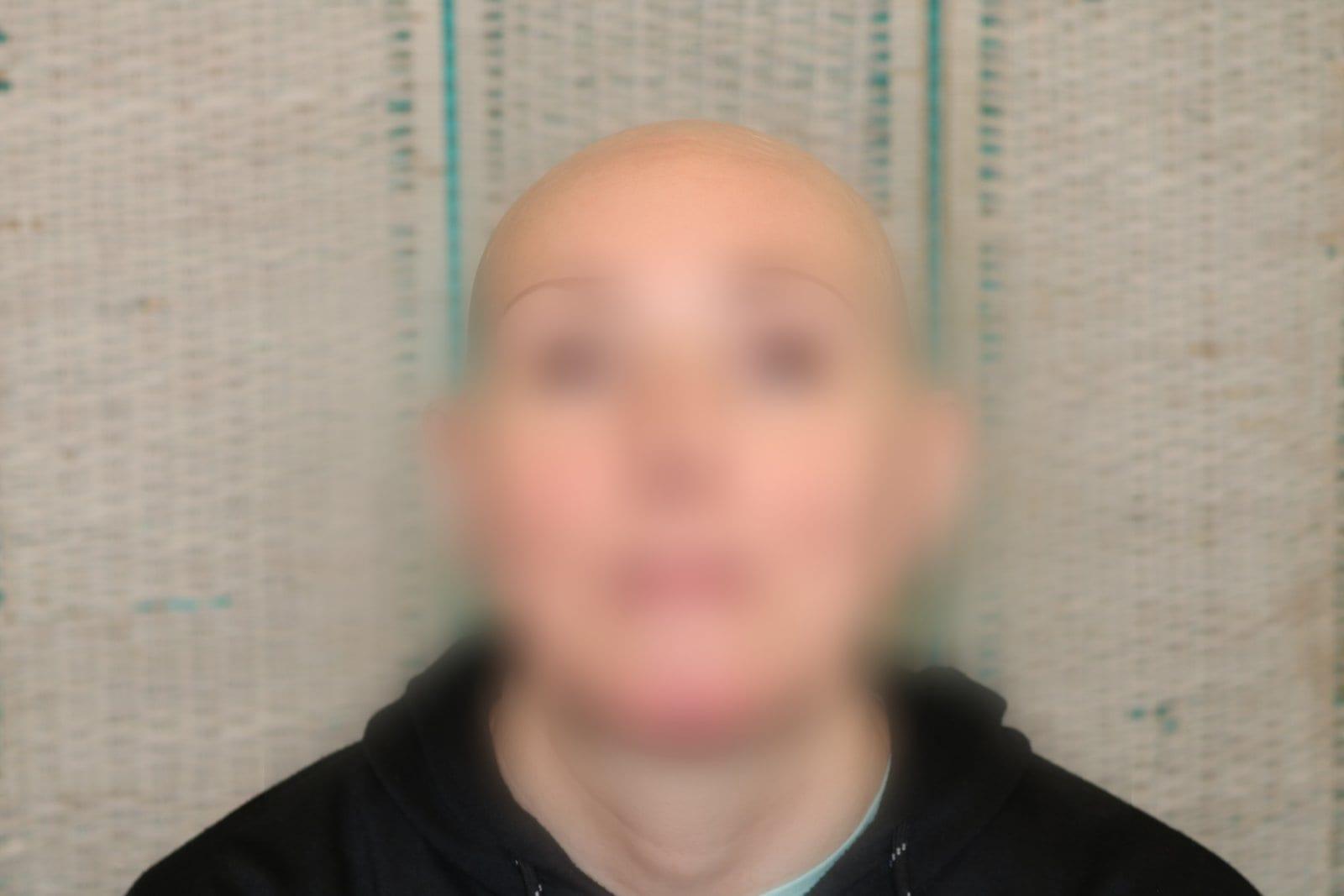 Prima: tricopigmentazione sezione donna a Firenze — Caso Prima / Dopo #5 (foto 8)