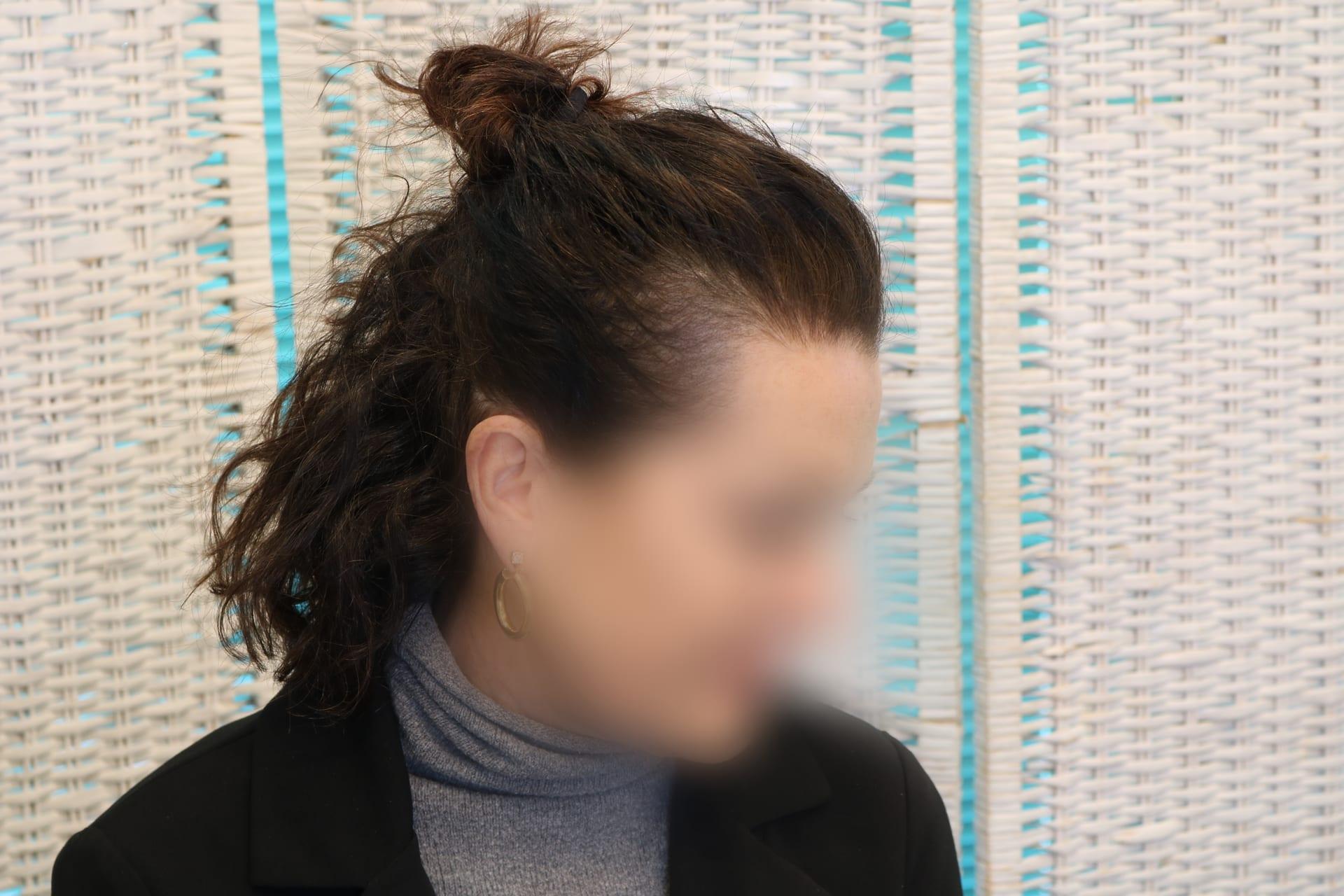 Prima: tricopigmentazione sezione donna a Firenze — Caso Prima / Dopo #6 (foto 10)