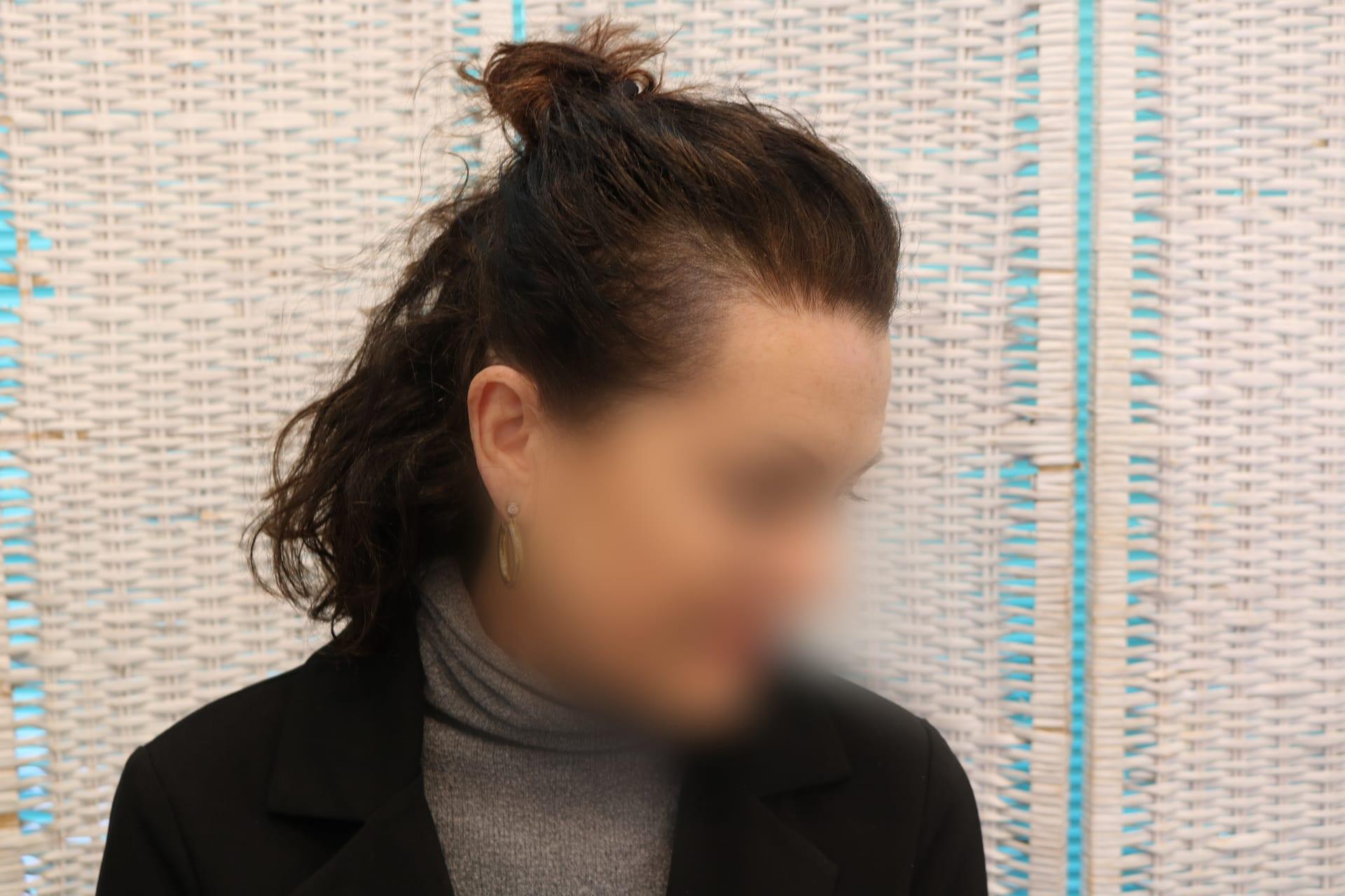 Prima: tricopigmentazione sezione donna a Firenze — Caso Prima / Dopo #6 (foto 11)