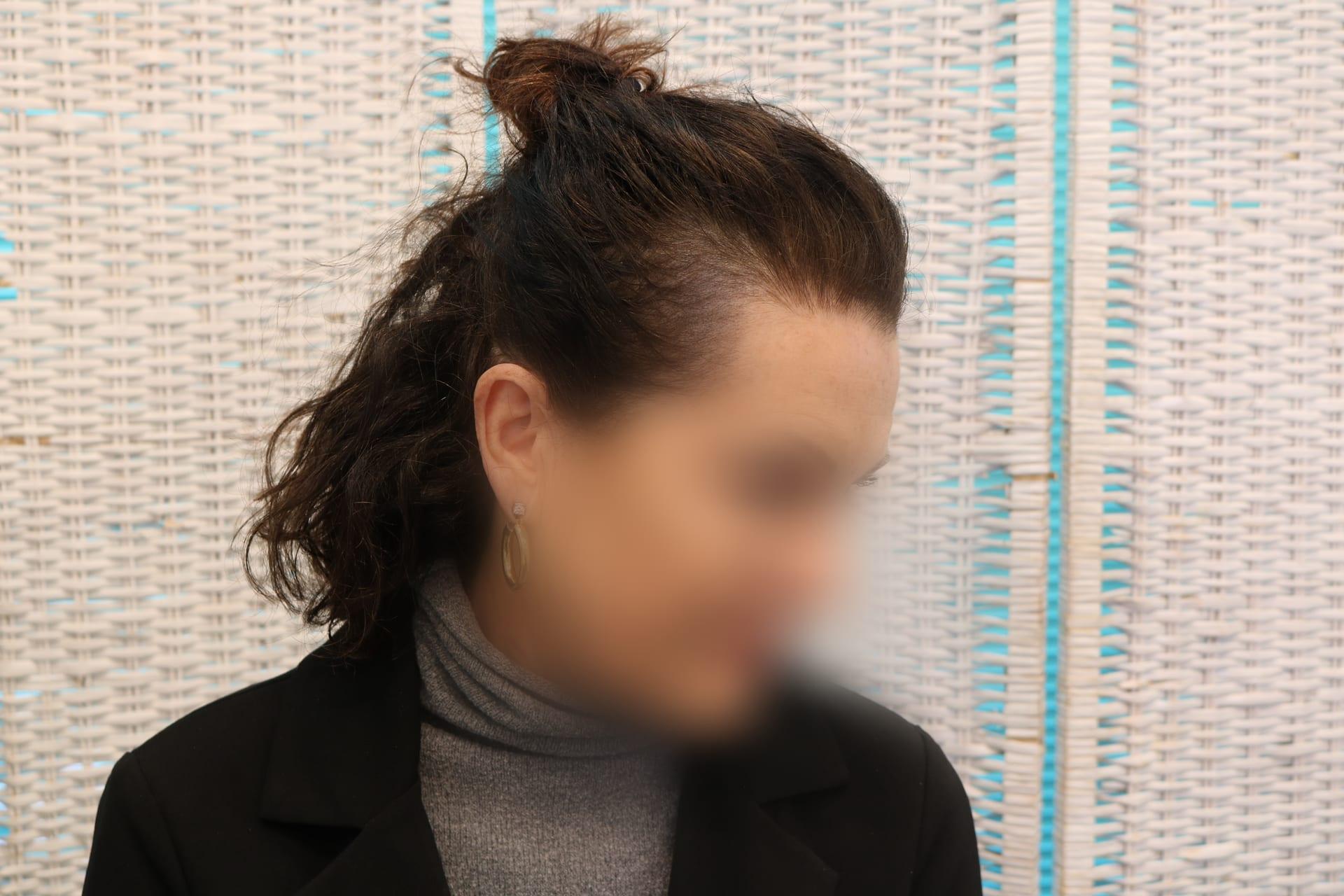 Prima: tricopigmentazione sezione donna a Firenze — Caso Prima / Dopo #6 (foto 12)