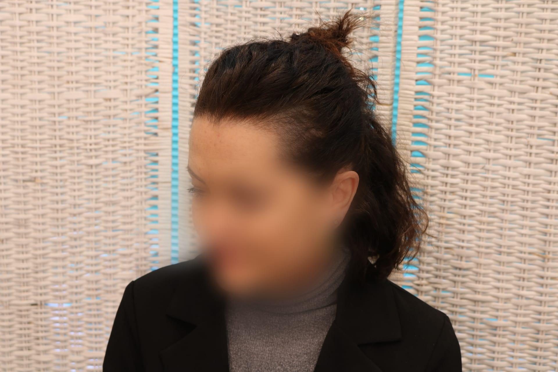 Prima: tricopigmentazione sezione donna a Firenze — Caso Prima / Dopo #6 (foto 13)