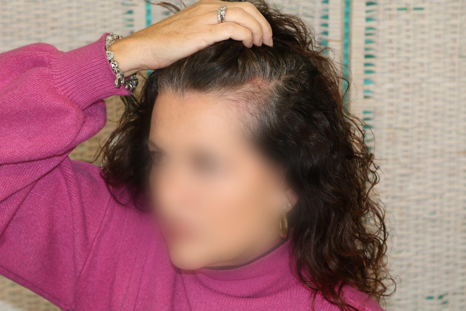 Prima: tricopigmentazione sezione donna a Firenze — Caso Prima / Dopo #6 (foto 2)
