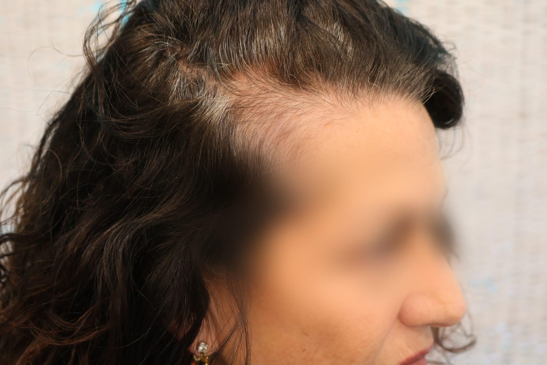 Prima: tricopigmentazione sezione donna a Firenze — Caso Prima / Dopo #6 (foto 3)