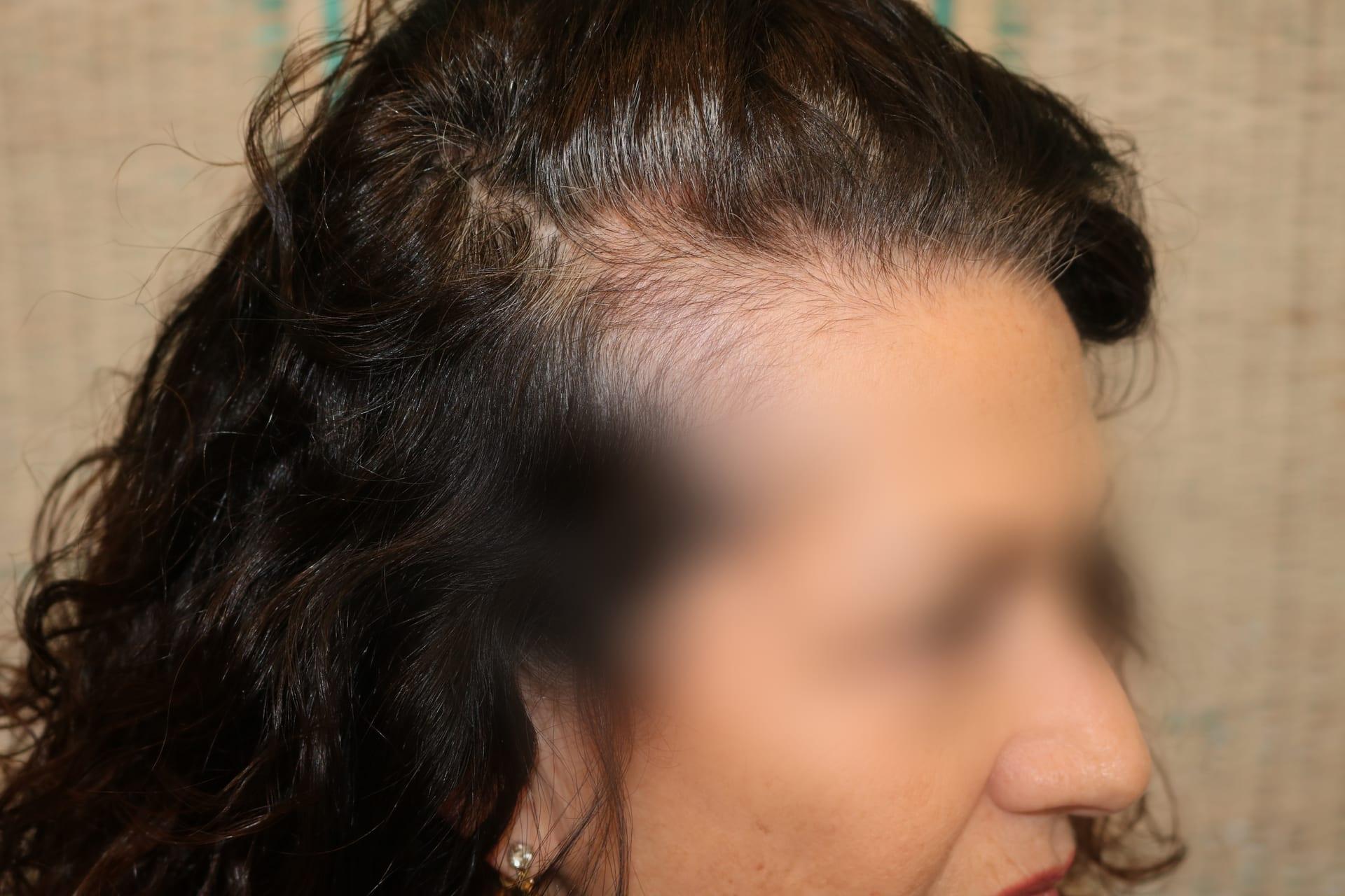 Prima: tricopigmentazione sezione donna a Firenze — Caso Prima / Dopo #6 (foto 4)