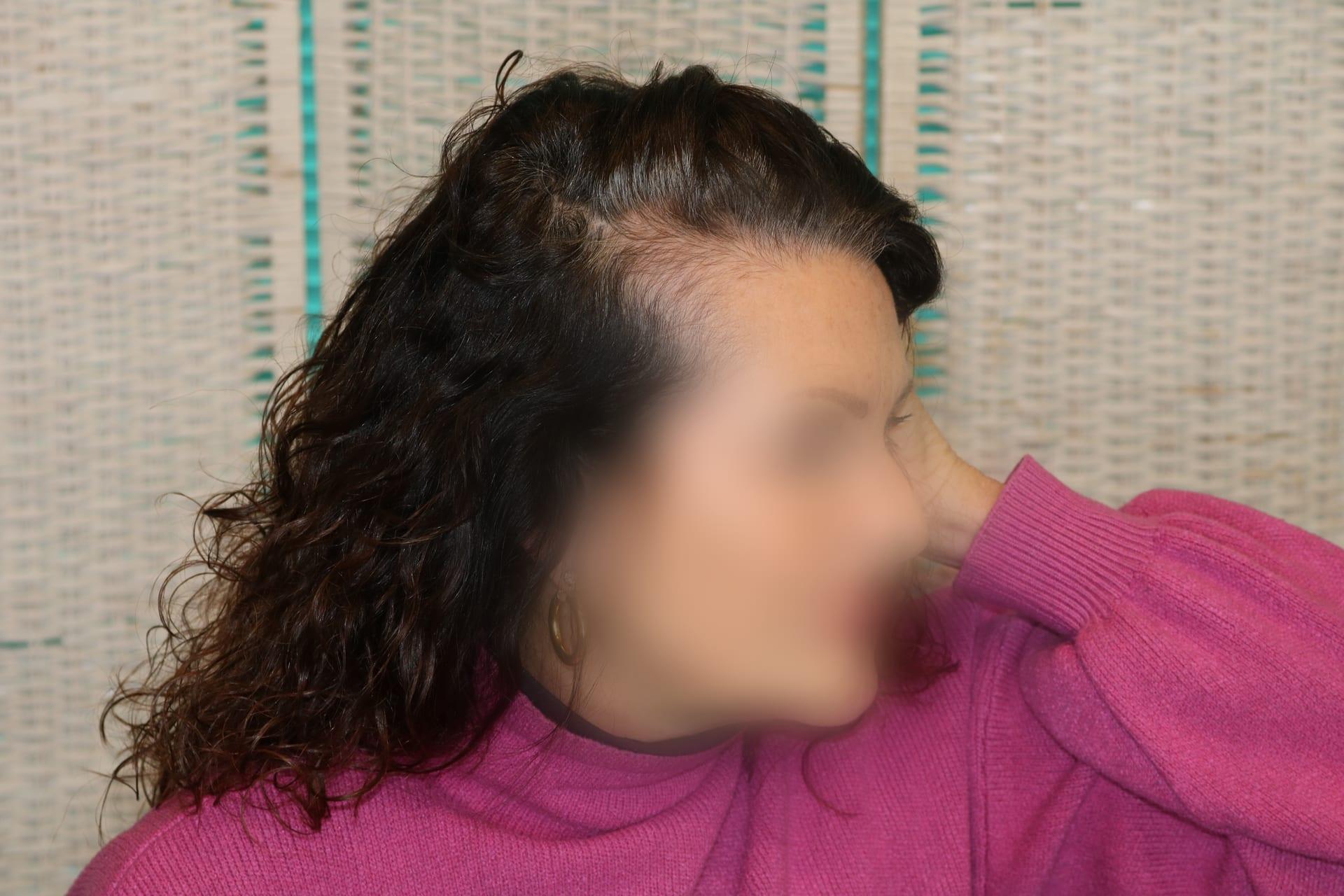 Prima: tricopigmentazione sezione donna a Firenze — Caso Prima / Dopo #6 (foto 5)