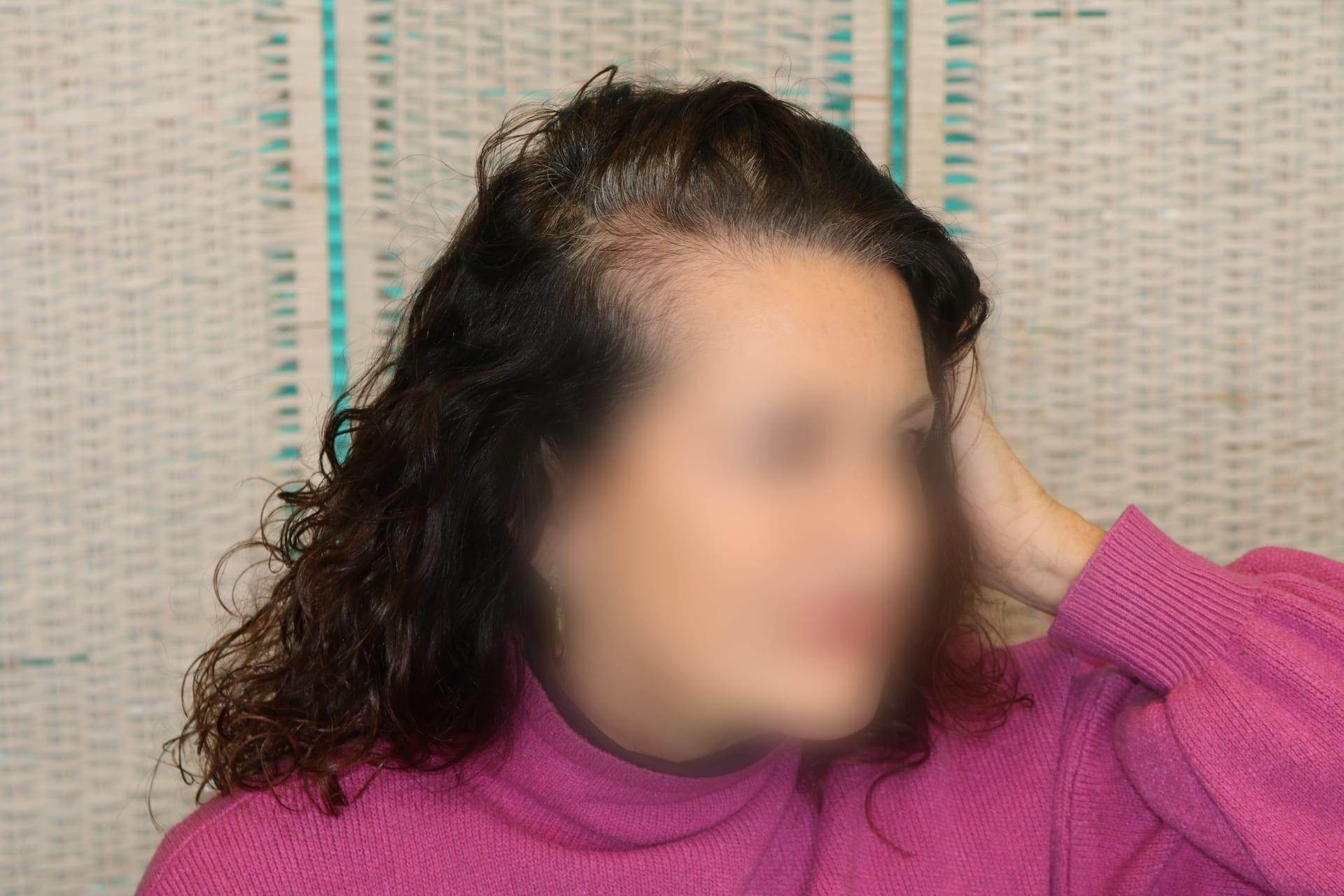 Prima: tricopigmentazione sezione donna a Firenze — Caso Prima / Dopo #6 (foto 6)