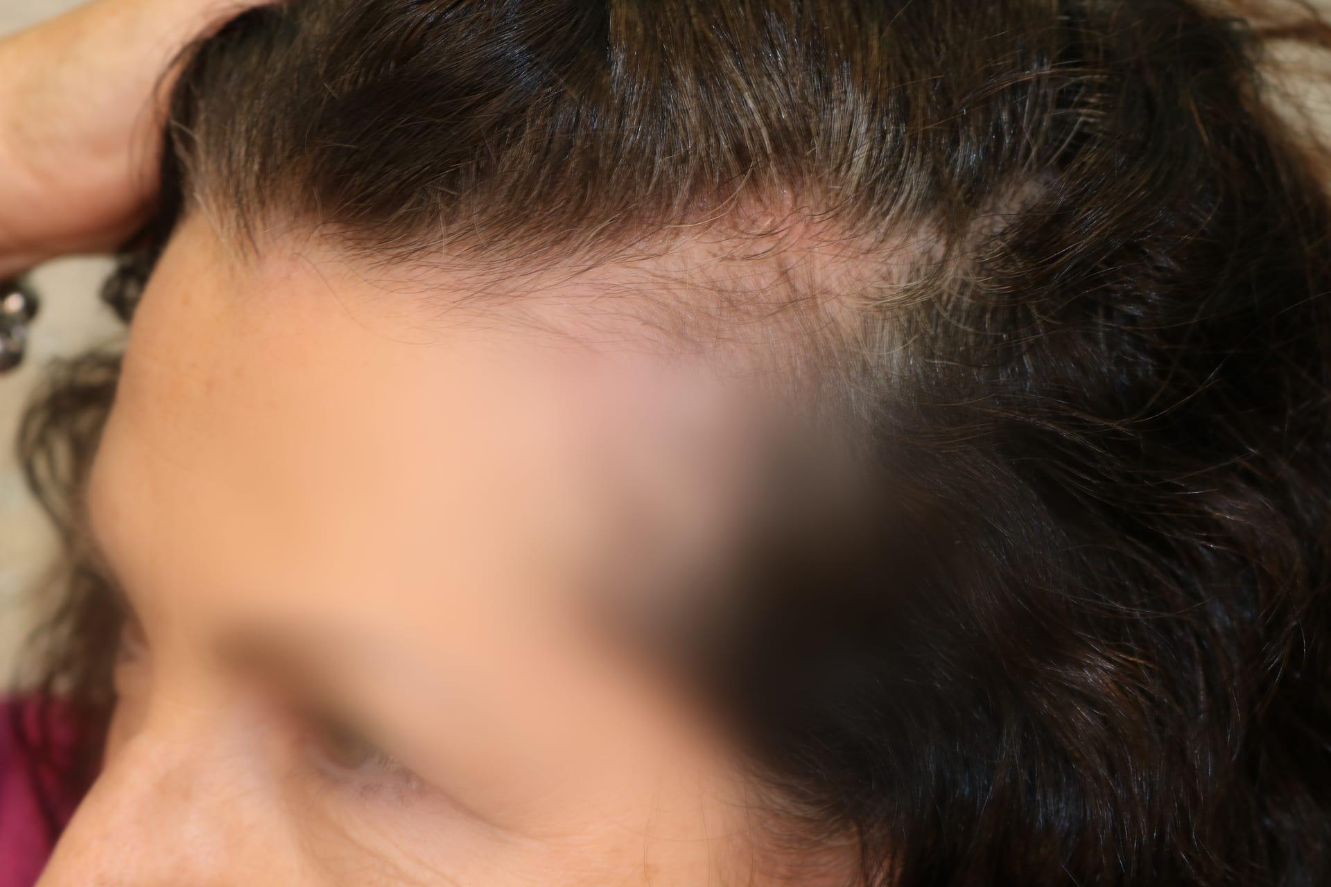 Prima: tricopigmentazione sezione donna a Firenze — Caso Prima / Dopo #6 (foto 7)