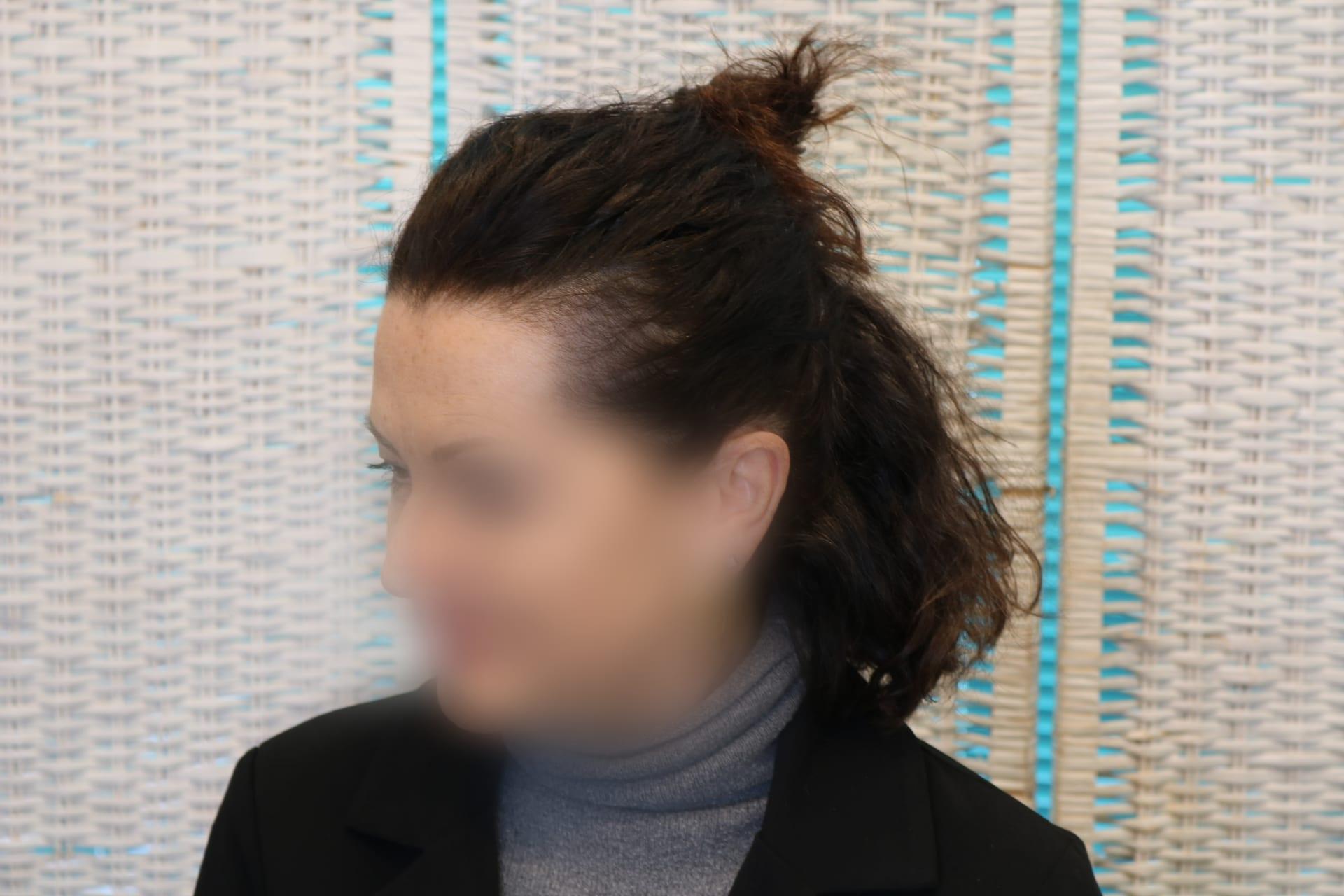 Prima: tricopigmentazione sezione donna a Firenze — Caso Prima / Dopo #6 (foto 8)