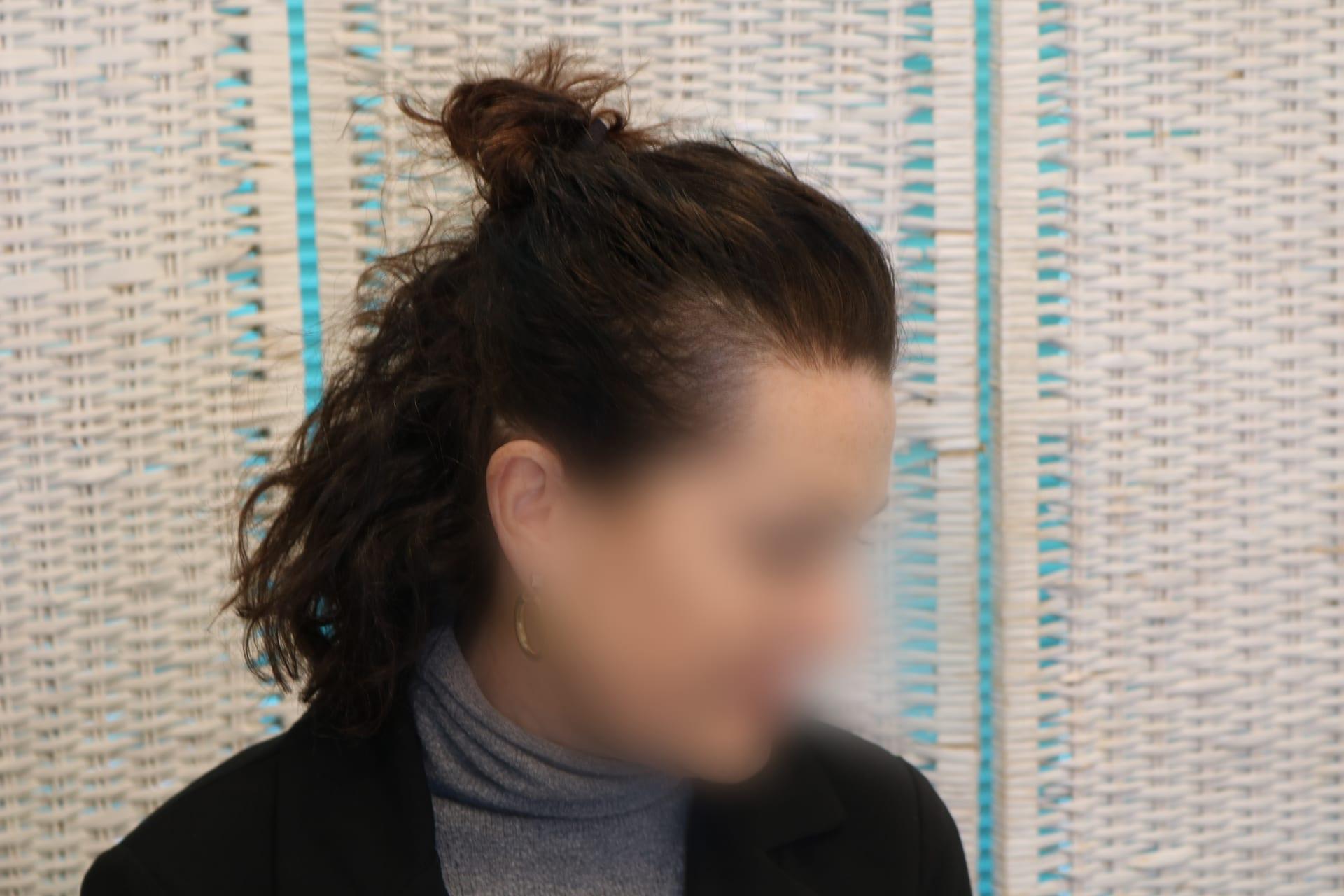 Prima: tricopigmentazione sezione donna a Firenze — Caso Prima / Dopo #6 (foto 9)