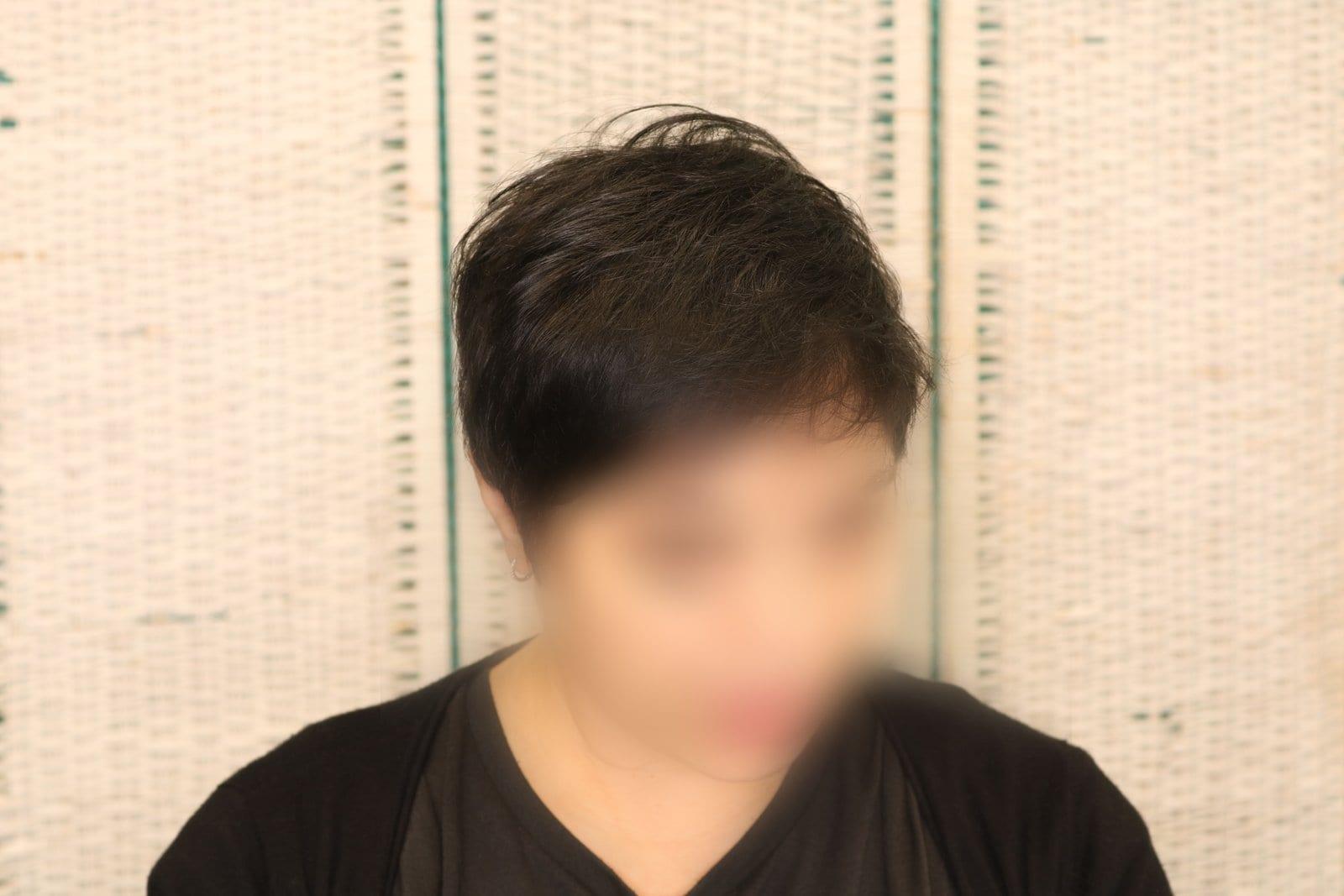 Dopo: tricopigmentazione sezione donna a Firenze — Caso Prima / Dopo #7 (foto 3)