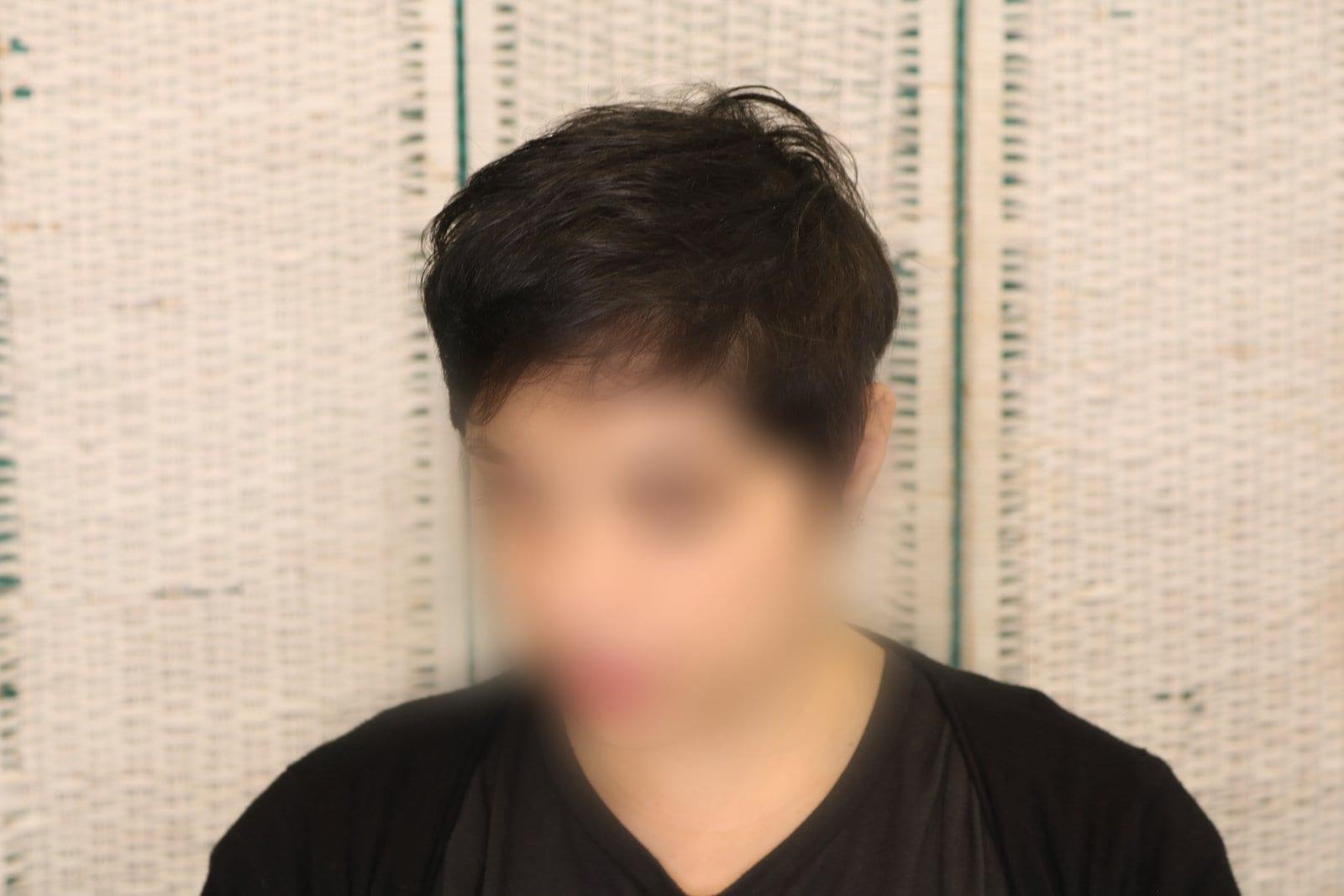 Dopo: tricopigmentazione sezione donna a Firenze — Caso Prima / Dopo #7 (foto 4)