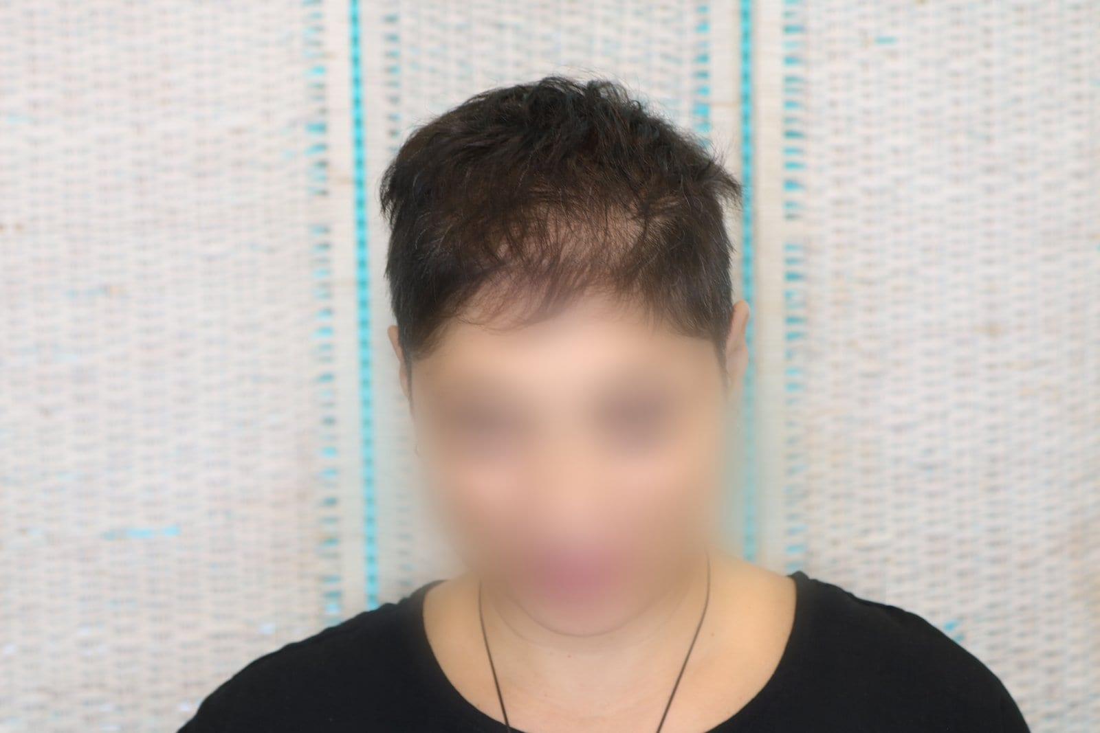 Prima: tricopigmentazione sezione donna a Firenze — Caso Prima / Dopo #7 (foto 1)