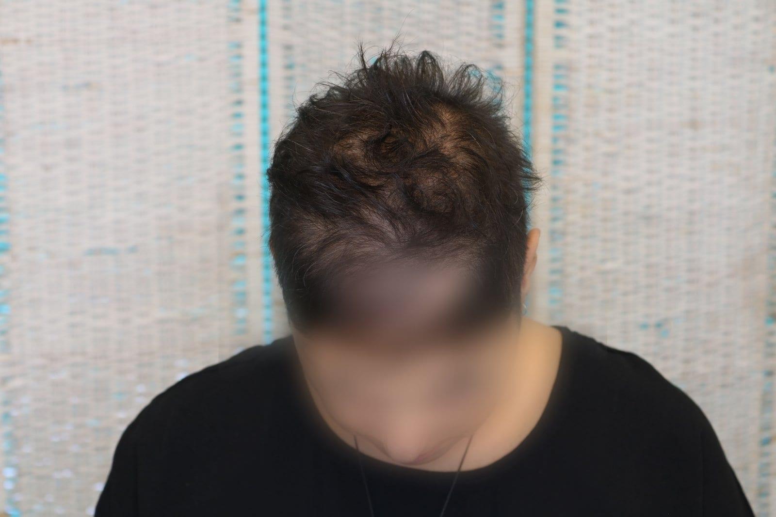 Prima: tricopigmentazione sezione donna a Firenze — Caso Prima / Dopo #7 (foto 2)