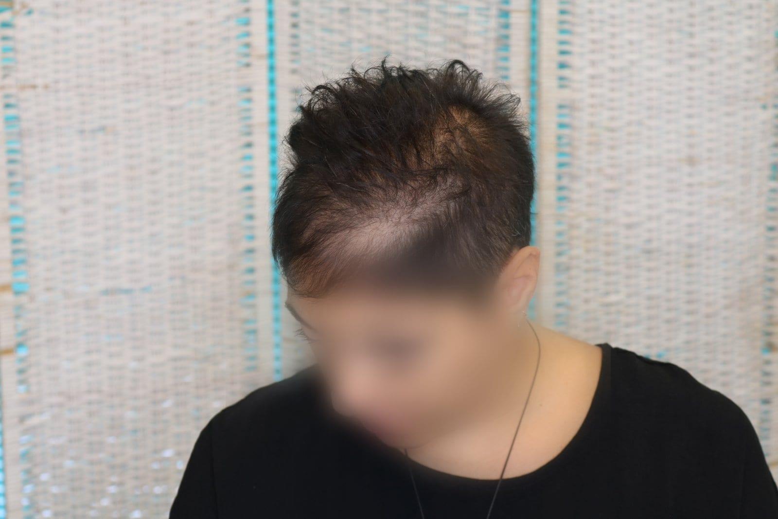 Prima: tricopigmentazione sezione donna a Firenze — Caso Prima / Dopo #7 (foto 3)