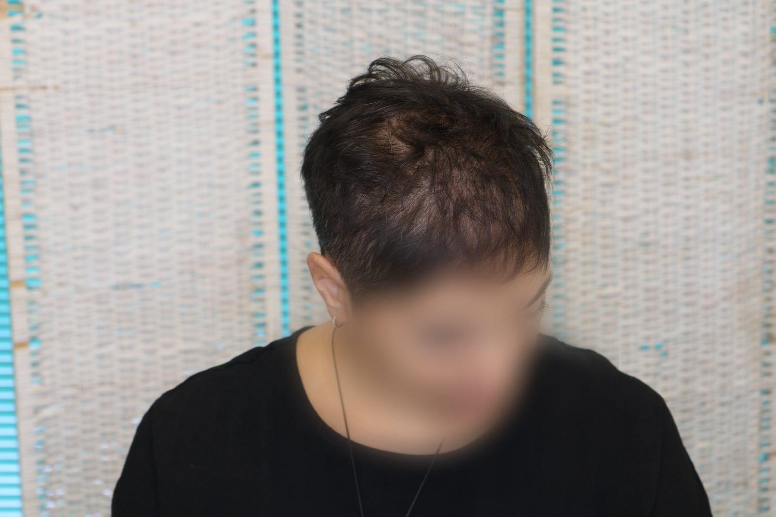 Prima: tricopigmentazione sezione donna a Firenze — Caso Prima / Dopo #7 (foto 4)