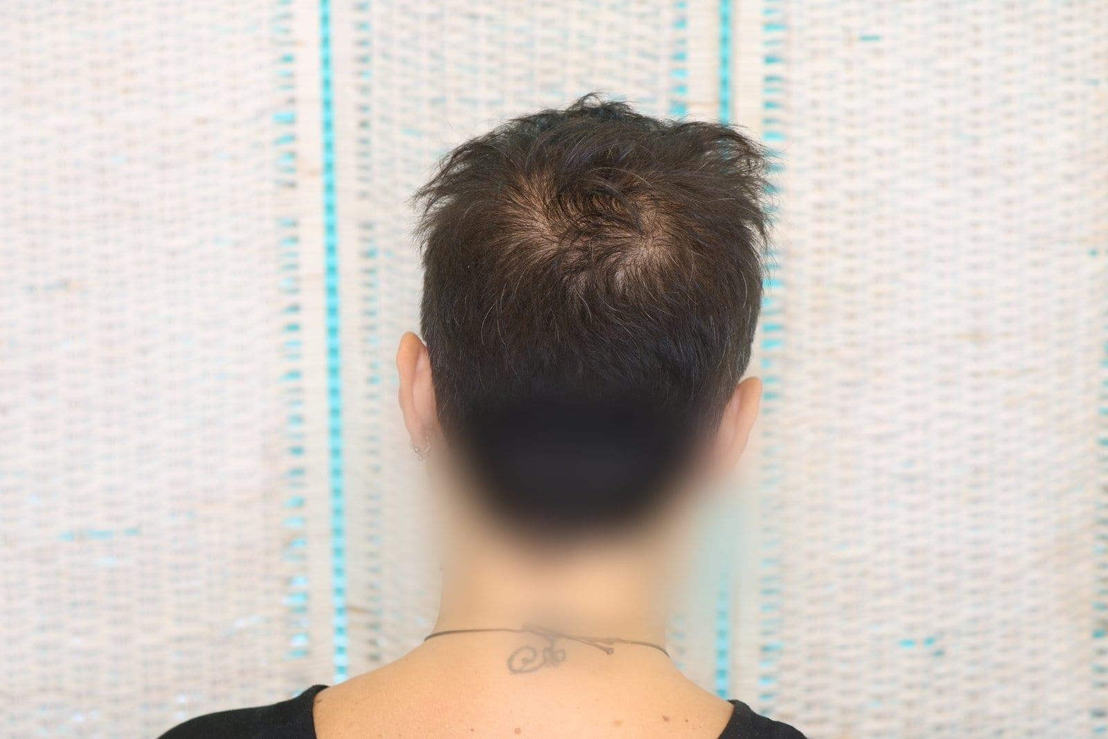 Prima: tricopigmentazione sezione donna a Firenze — Caso Prima / Dopo #7 (foto 5)