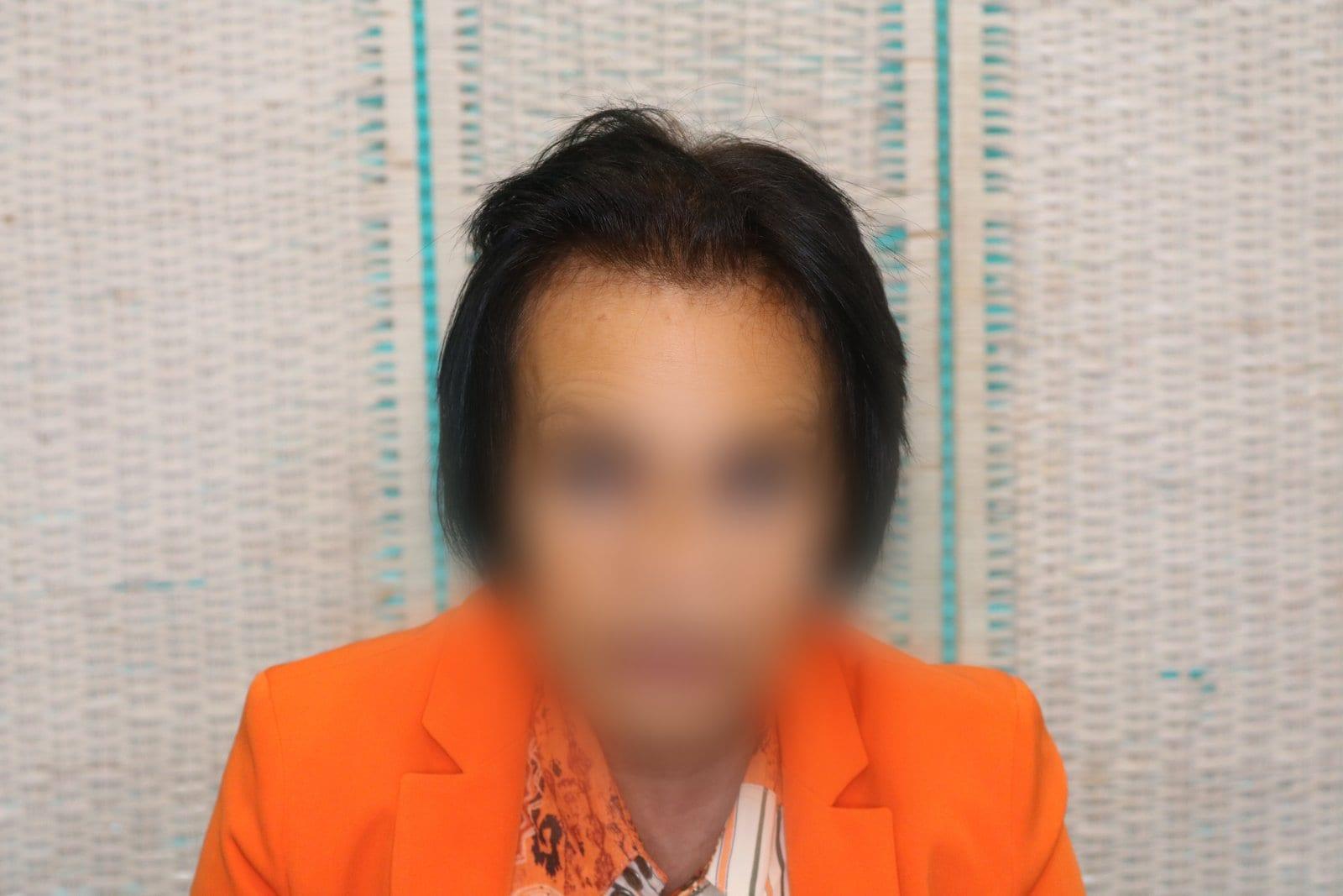 Prima: tricopigmentazione sezione donna a Firenze — Caso Prima / Dopo #8 (foto 10)