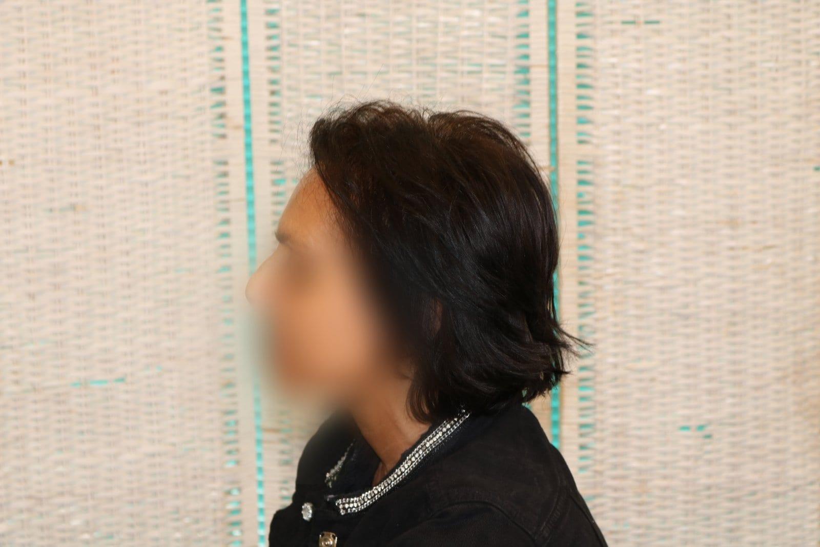 Prima: tricopigmentazione sezione donna a Firenze — Caso Prima / Dopo #8 (foto 3)