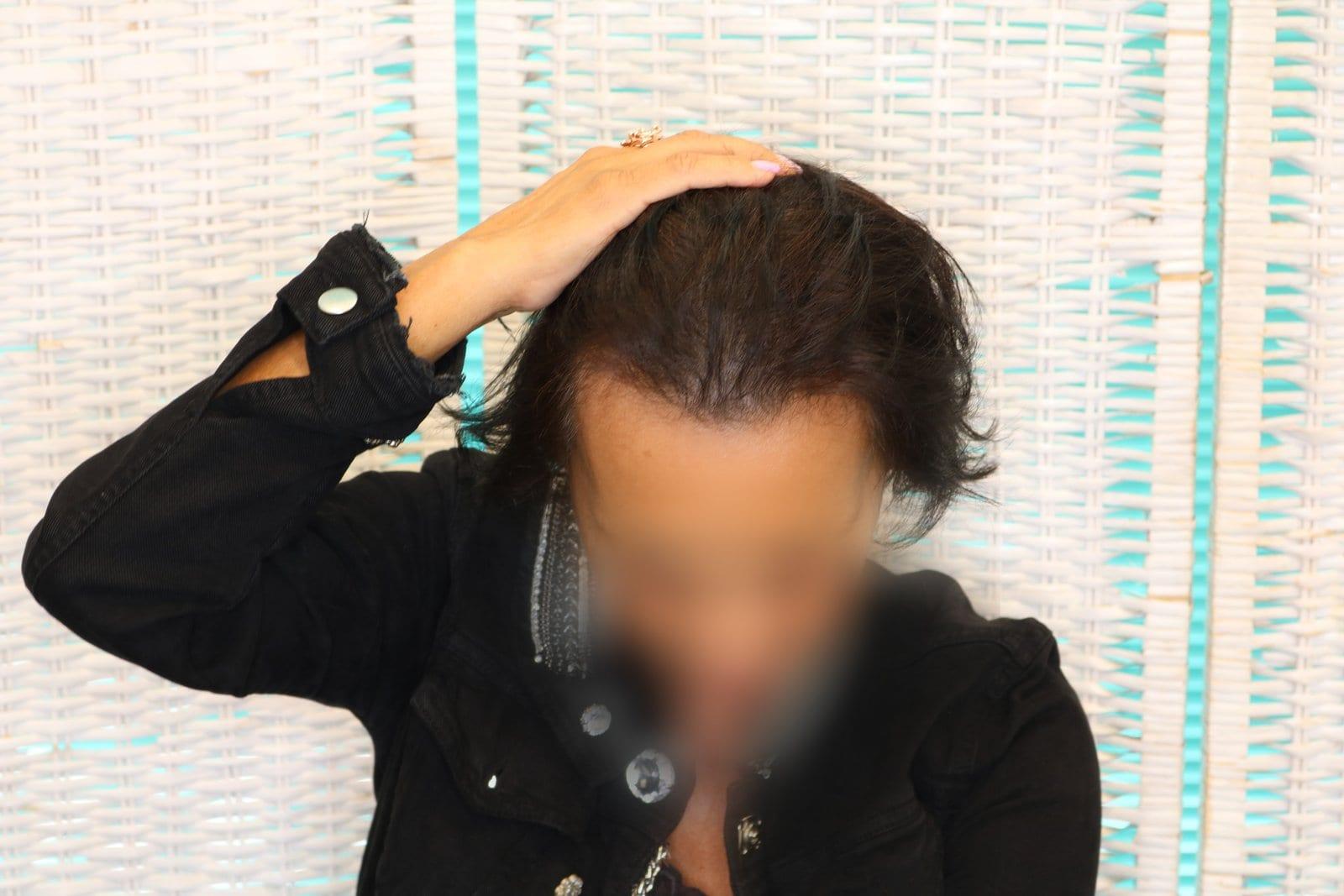 Prima: tricopigmentazione sezione donna a Firenze — Caso Prima / Dopo #8 (foto 4)