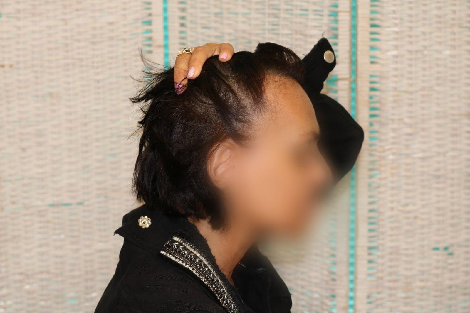 Prima: tricopigmentazione sezione donna a Firenze — Caso Prima / Dopo #8 (foto 5)