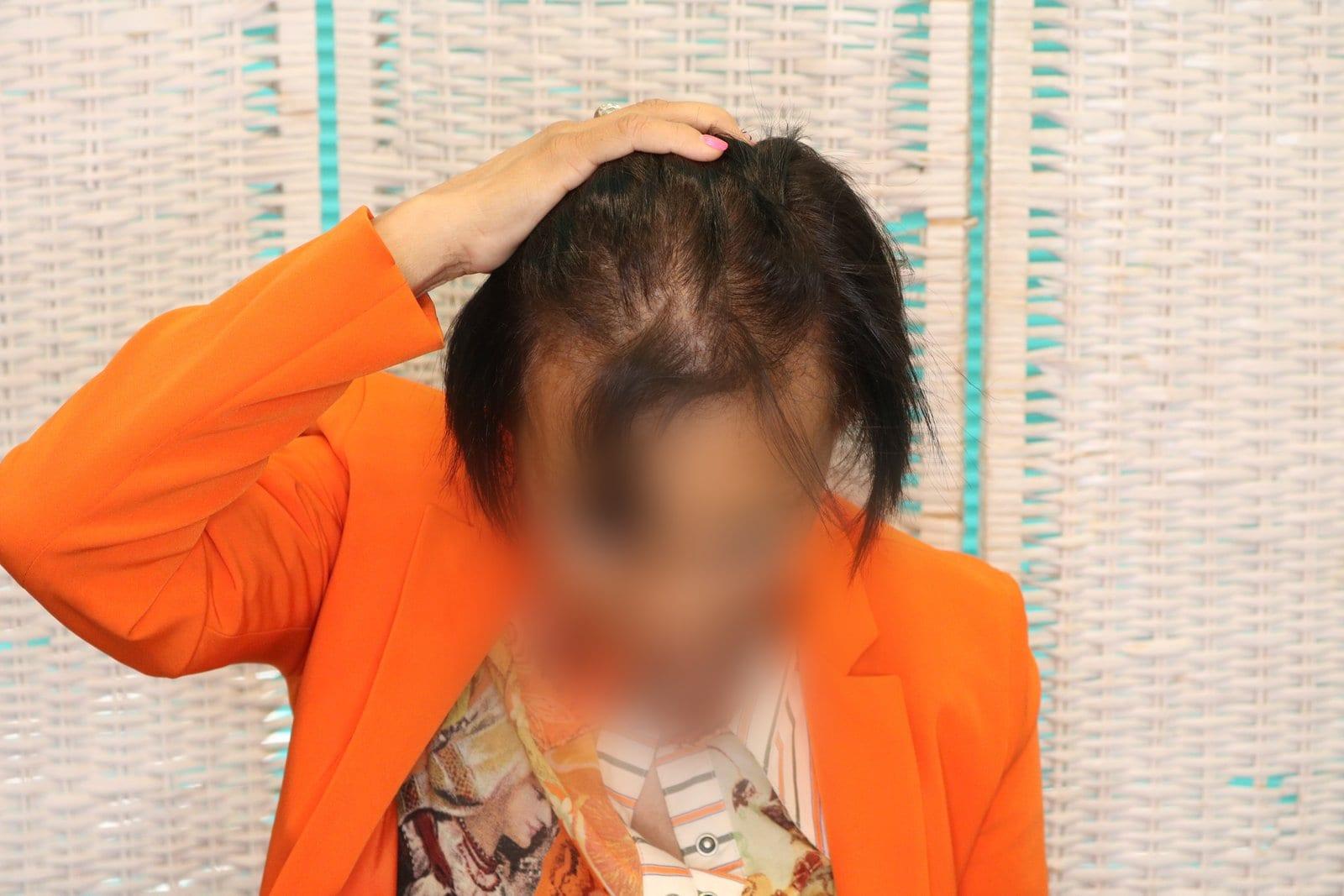 Prima: tricopigmentazione sezione donna a Firenze — Caso Prima / Dopo #8 (foto 6)