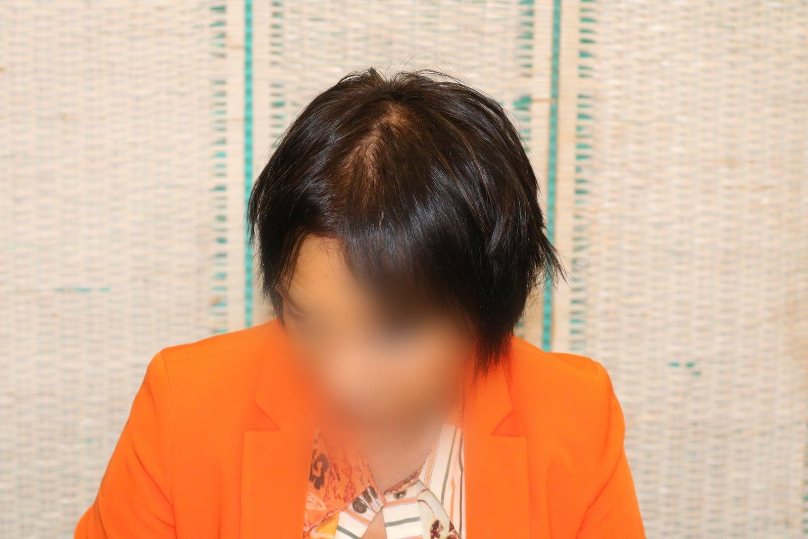Prima: tricopigmentazione sezione donna a Firenze — Caso Prima / Dopo #8 (foto 9)