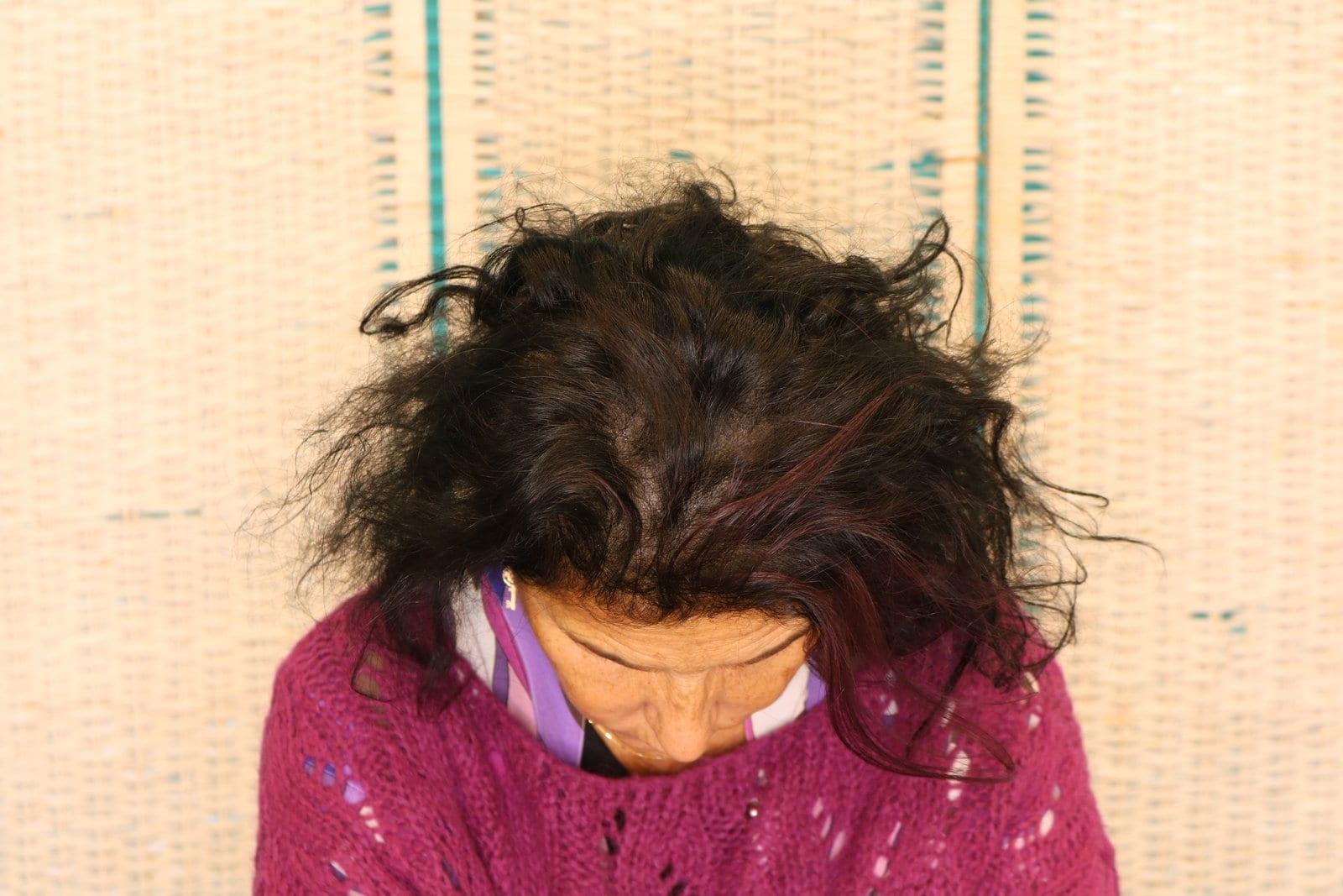 Dopo: tricopigmentazione sezione donna a Firenze — Caso Prima / Dopo #9 (foto 2)