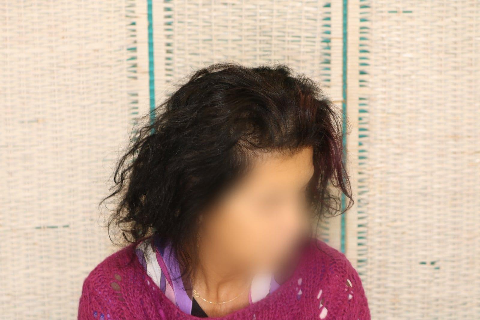 Dopo: tricopigmentazione sezione donna a Firenze — Caso Prima / Dopo #9 (foto 6)