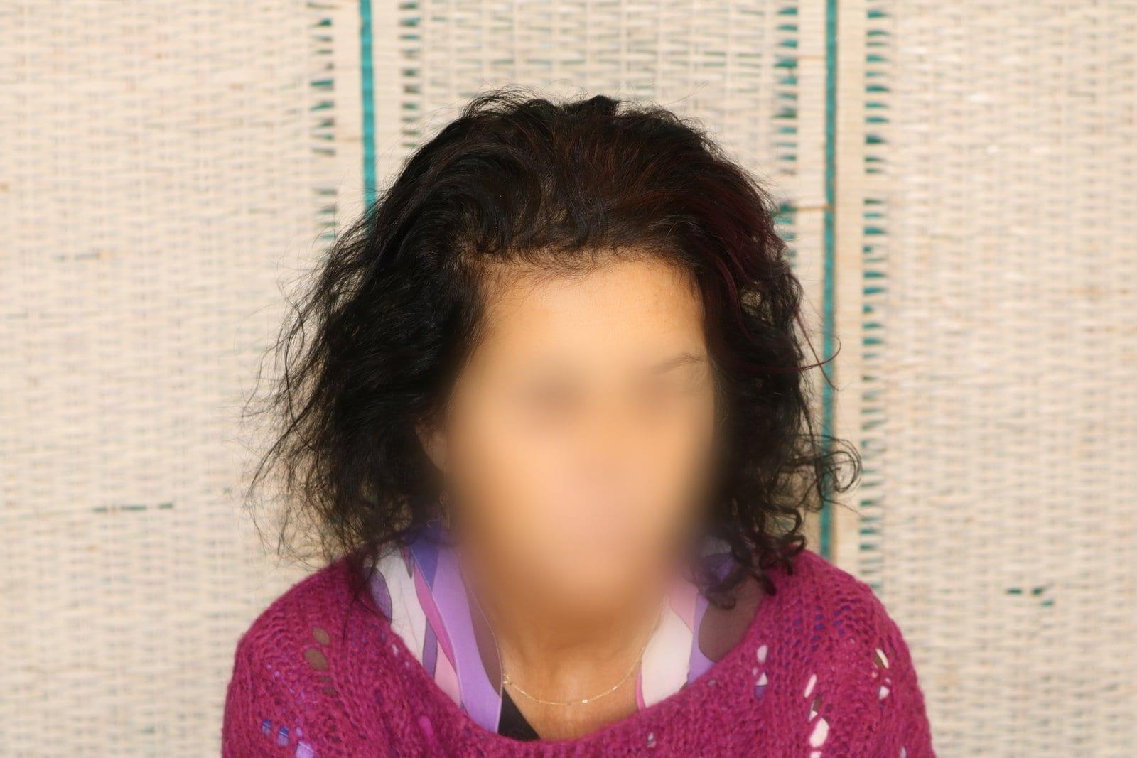 Dopo: tricopigmentazione sezione donna a Firenze — Caso Prima / Dopo #9 (foto 7)