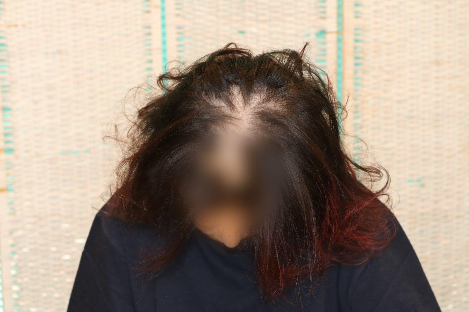 Prima: tricopigmentazione sezione donna a Firenze — Caso Prima / Dopo #9 (foto 1)
