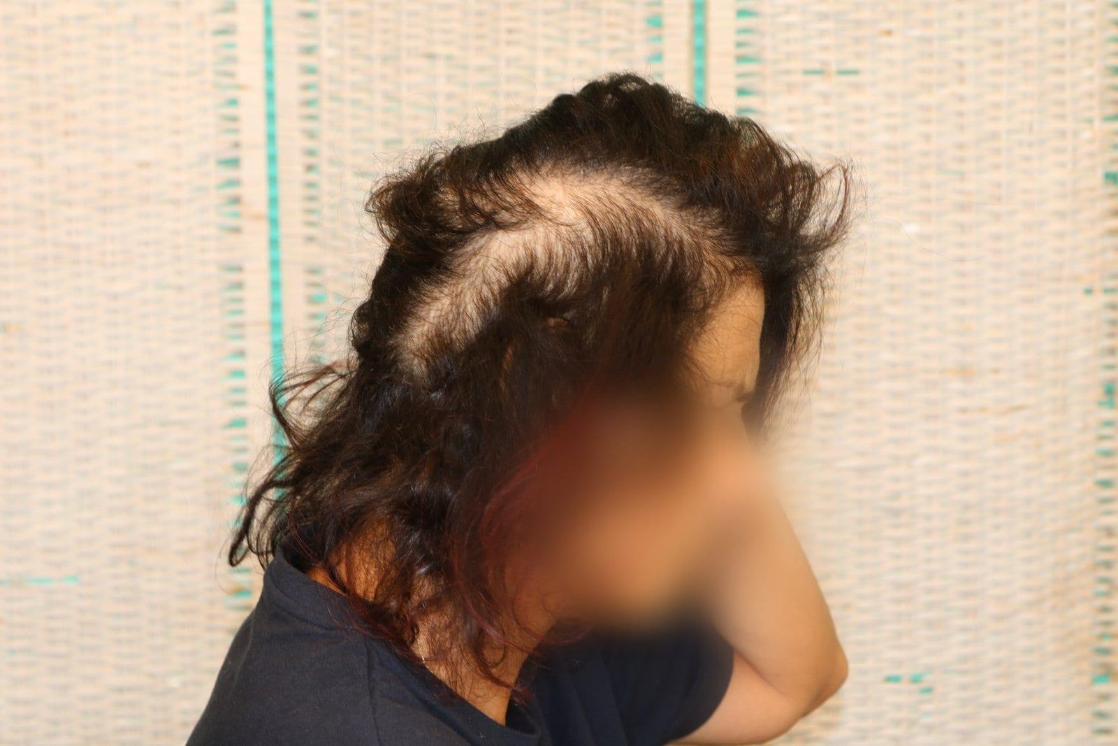 Prima: tricopigmentazione sezione donna a Firenze — Caso Prima / Dopo #9 (foto 2)