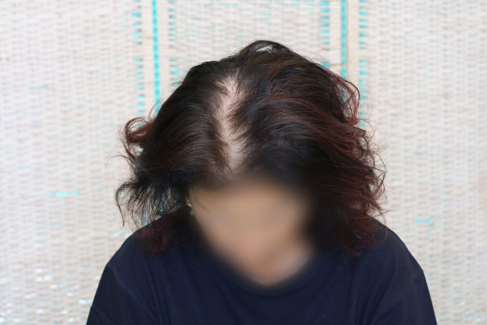 Prima: tricopigmentazione sezione donna a Firenze — Caso Prima / Dopo #9 (foto 3)