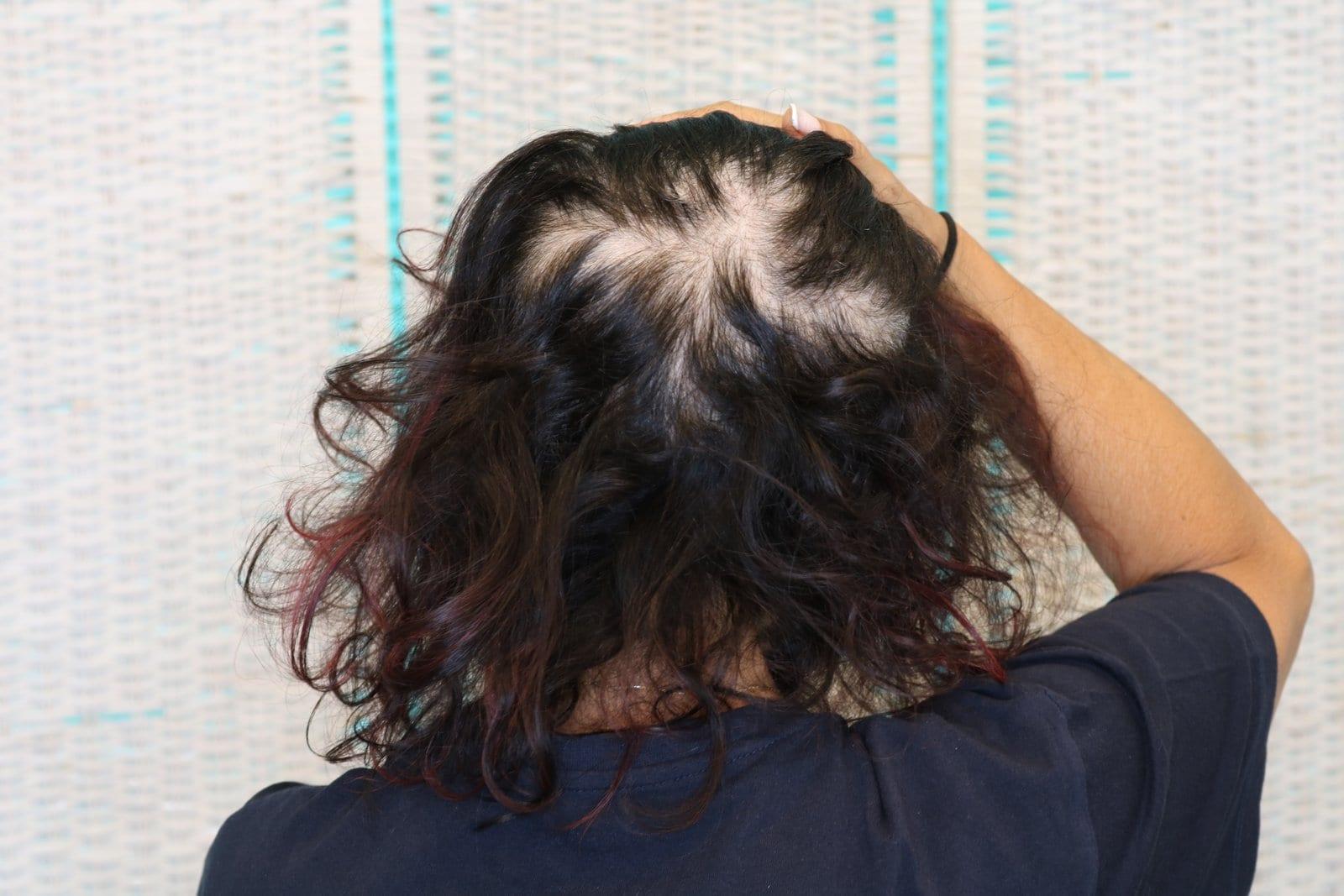 Prima: tricopigmentazione sezione donna a Firenze — Caso Prima / Dopo #9 (foto 5)