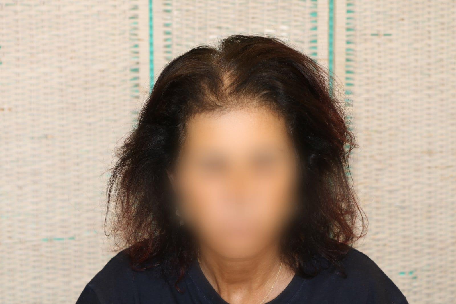 Prima: tricopigmentazione sezione donna a Firenze — Caso Prima / Dopo #9 (foto 8)