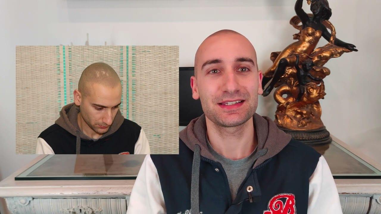 Tricopigmentazione: Jonathan — da titubante a soddisfatto (“con un vero professionista non rischi”)