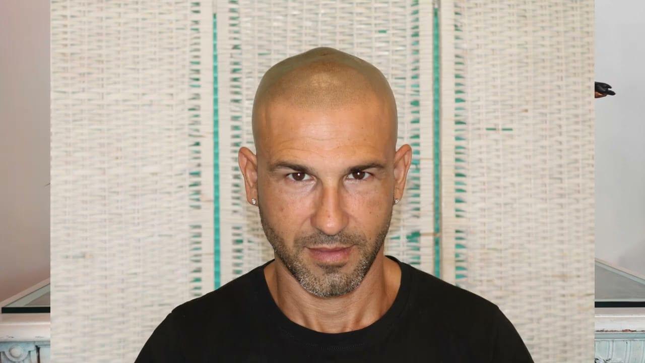 Testimonianza video di un cliente — tricopigmentazione