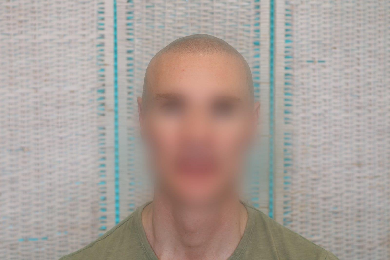 Tricopigmentazione, dopo, caso #24, Firenze