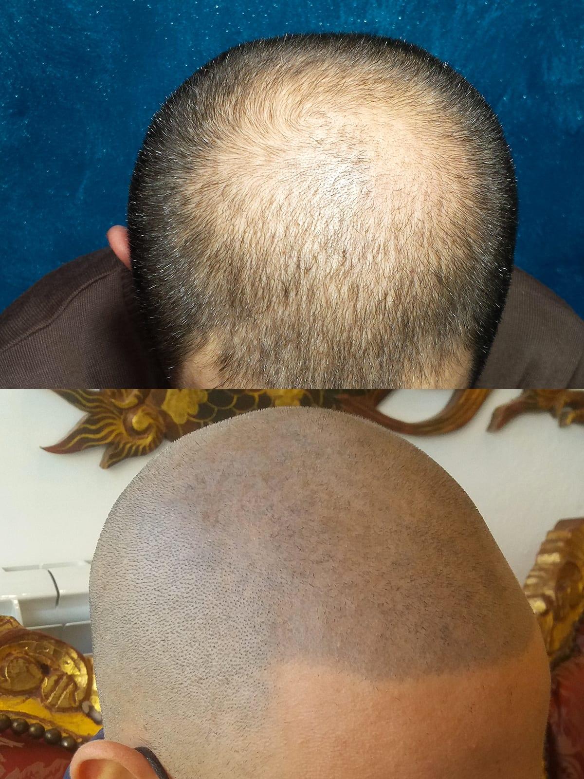 Tricopigmentazione, prima e dopo, caso #21, Firenze