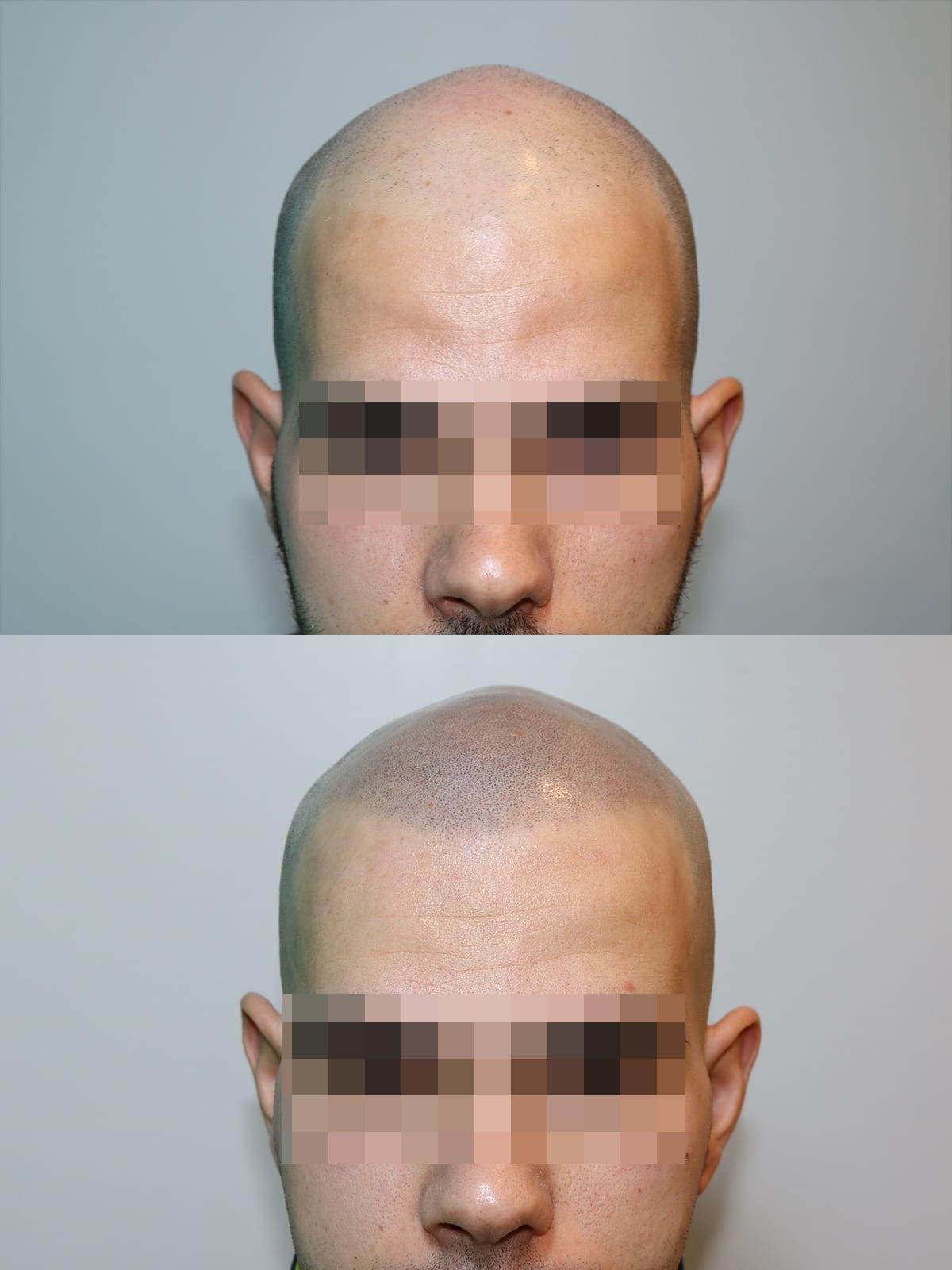 Tricopigmentazione, prima e dopo, caso #23, Firenze