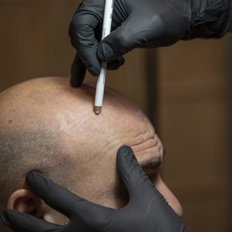 Tatuaggio Capelli: Si Vede che è Finto? La Verità da un Esperto